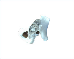 Fractured Acetabulum Model