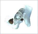 Hip Deformities Image